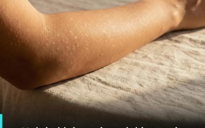 Welke vitaminetekorten kunnen leiden tot witte vlekken op de huid?