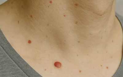 Die kleine rode vlekjes op je huid: moet je je daar zorgen over maken?
