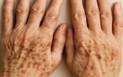 🖐️Vlekjes op de handen: zijn ze een teken van melanoom, de gevaarlijkste vorm van huidkanker?