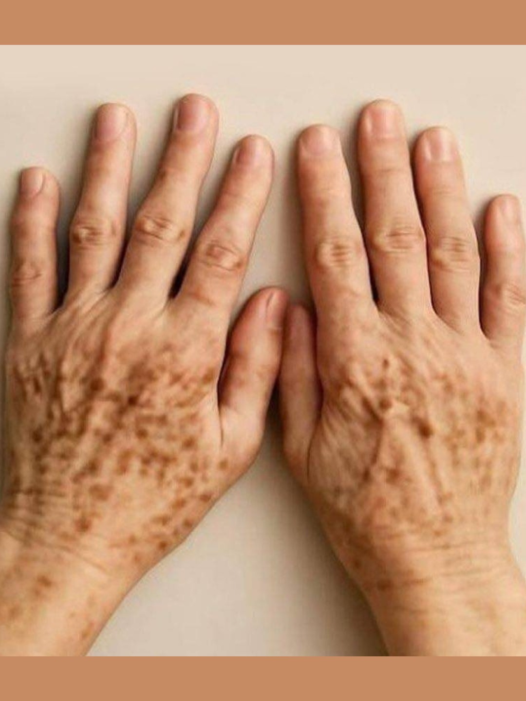 🖐️Vlekjes op de handen: zijn ze een teken van melanoom, de gevaarlijkste vorm van huidkanker?