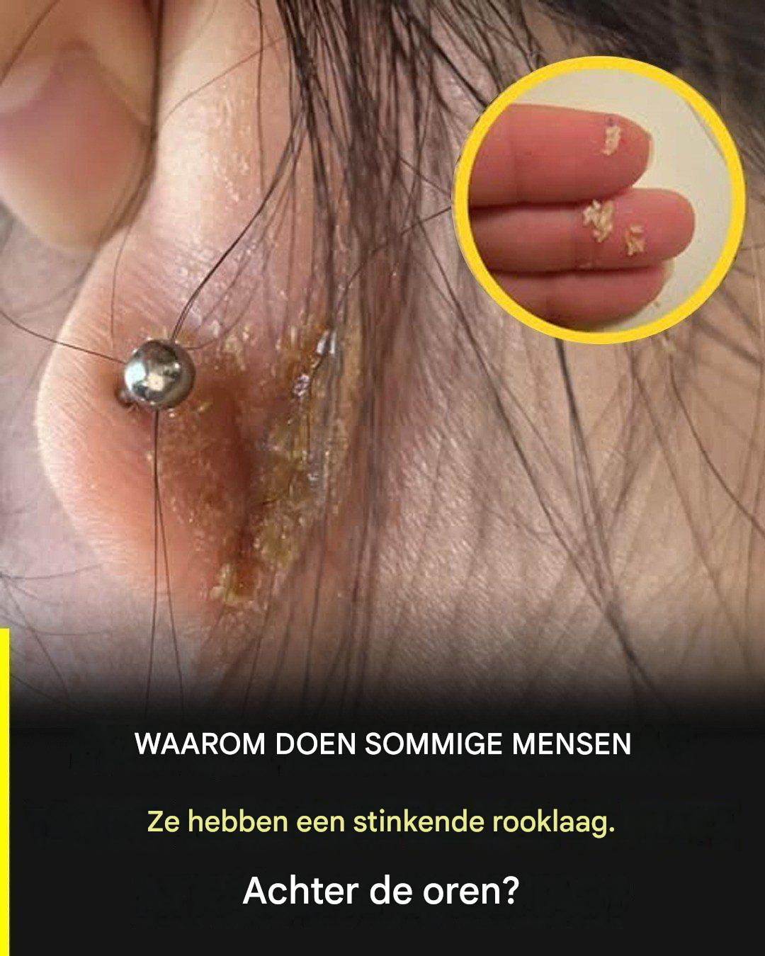 Geur van korstjes achter de oren: de werkelijke oorzaken en hoe je het probleem vroegtijdig kunt herkennen.