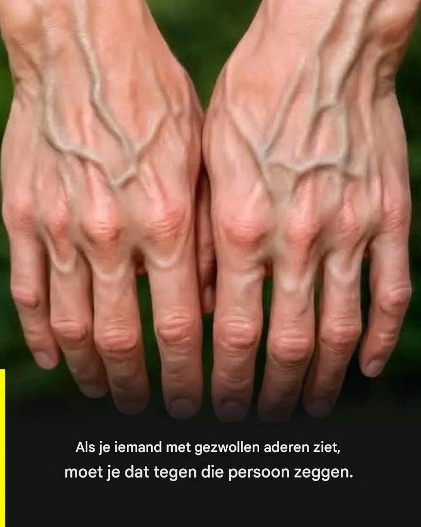 Als je aderen zichtbaar zijn, betekent dit dat… Lees meer
