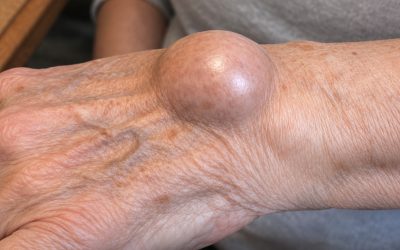 Lipoom: oorzaken, symptomen en natuurlijke oplossingen om deze vetophoping te verminderen