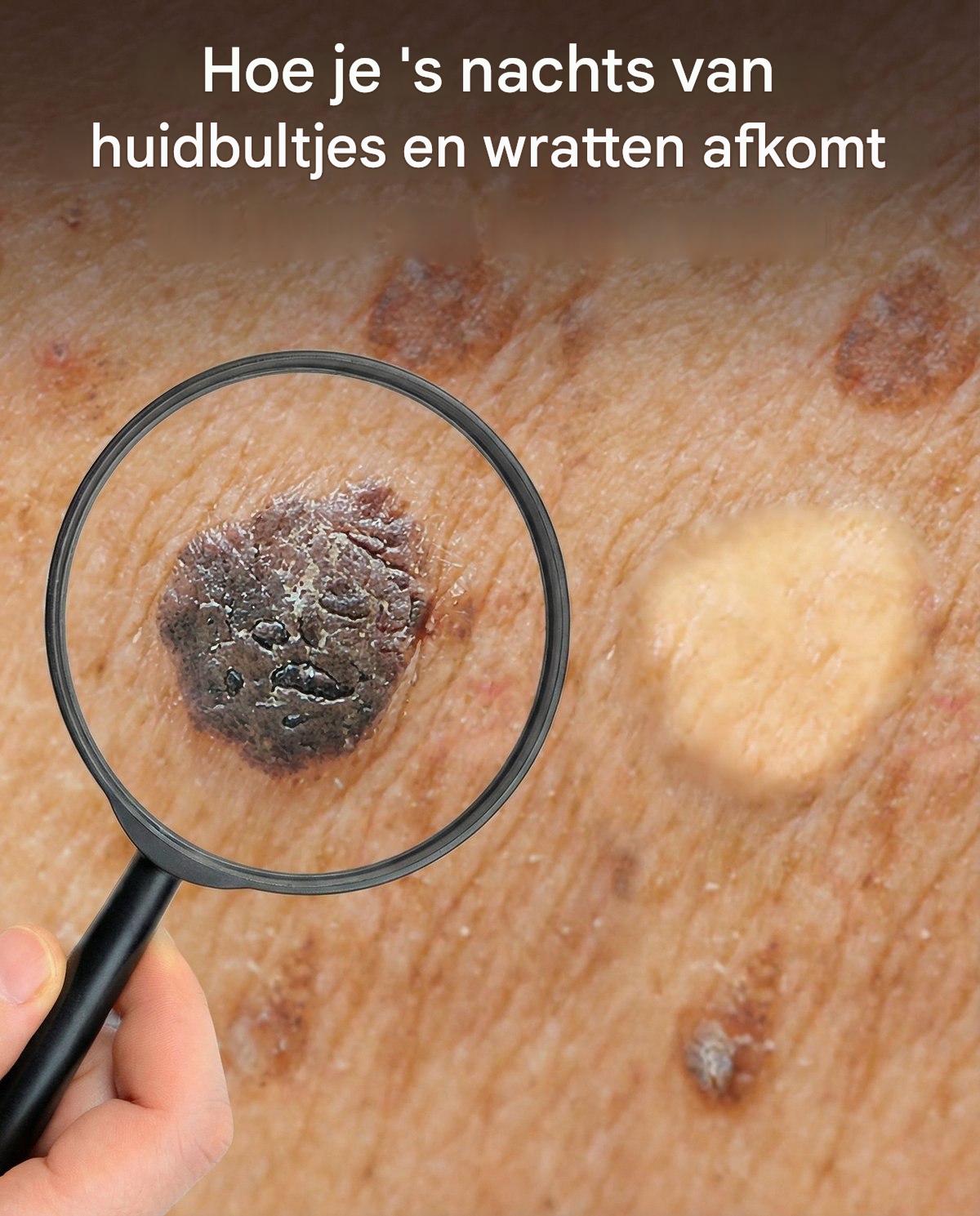 Hoe verwijder je huidbultjes en wratten in één nacht?