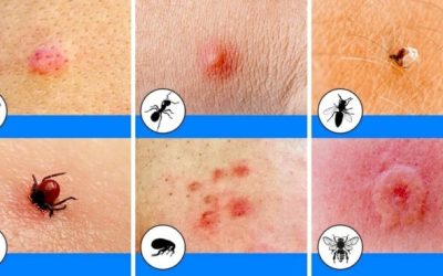 Insectenbeten onderscheiden en de juiste behandeling kiezen
