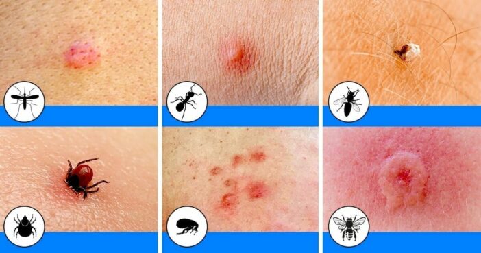 Insectenbeten onderscheiden en de juiste behandeling kiezen