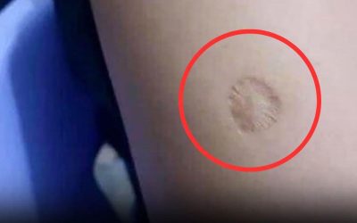 Het kleine ronde litteken op je arm