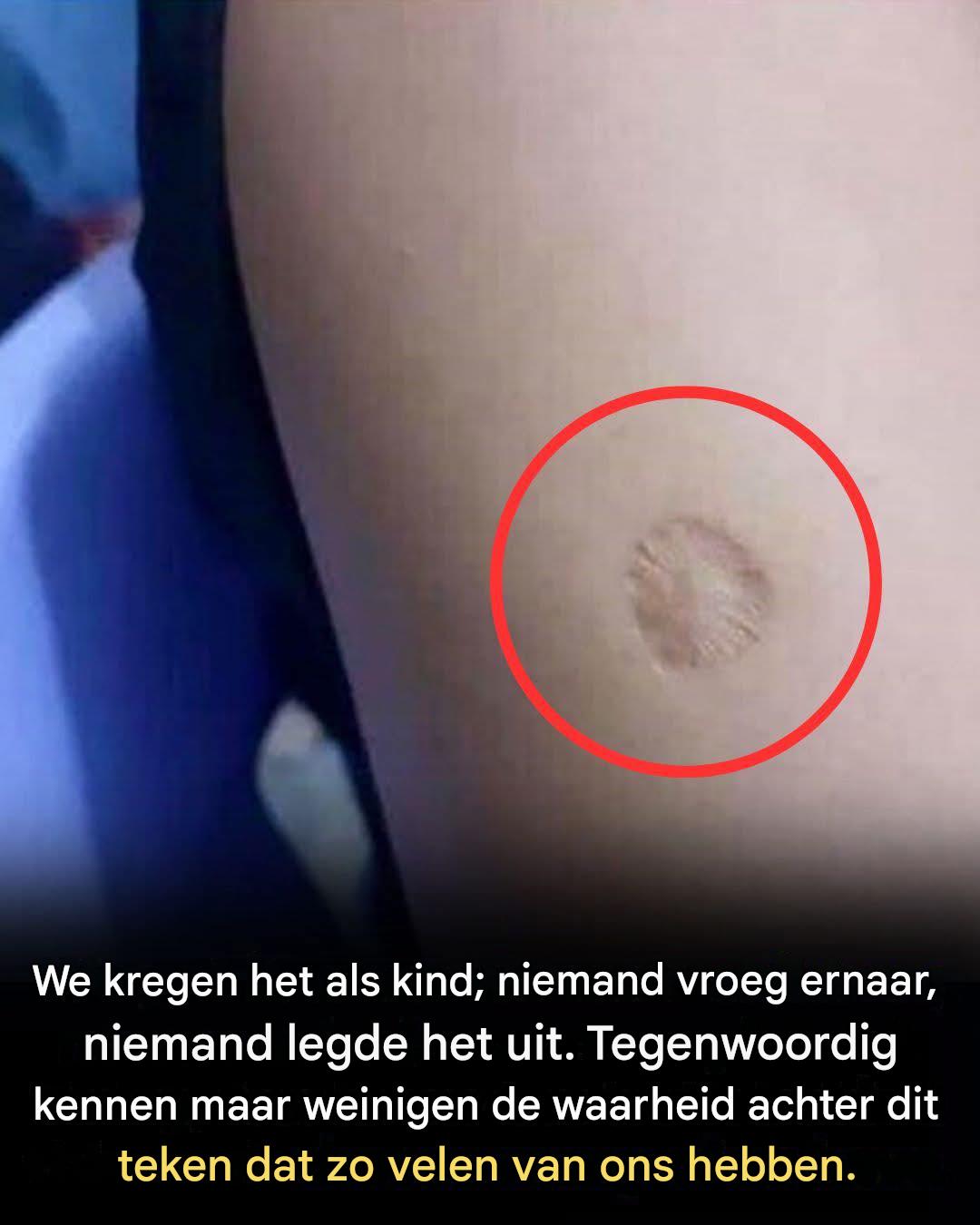 Het kleine ronde litteken op je arm