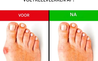 Effectieve oplossingen voor het verlichten en voorkomen van hallux valgus.