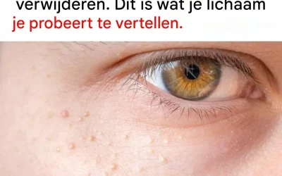 Witte bultjes op de huid: waarom je ze beter niet zelf kunt verwijderen!