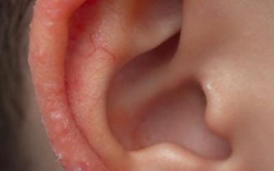 Ik zag vanochtend een vreemd plekje op het oor van mijn zoon. Zijn doktersafspraak is pas over een week – wat kan ik in de tussentijd doen?