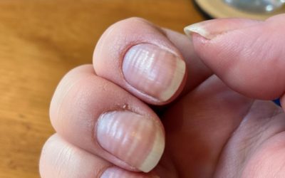 Als je ribbels in je vingernagels hebt opgemerkt, betekent dit het echt.