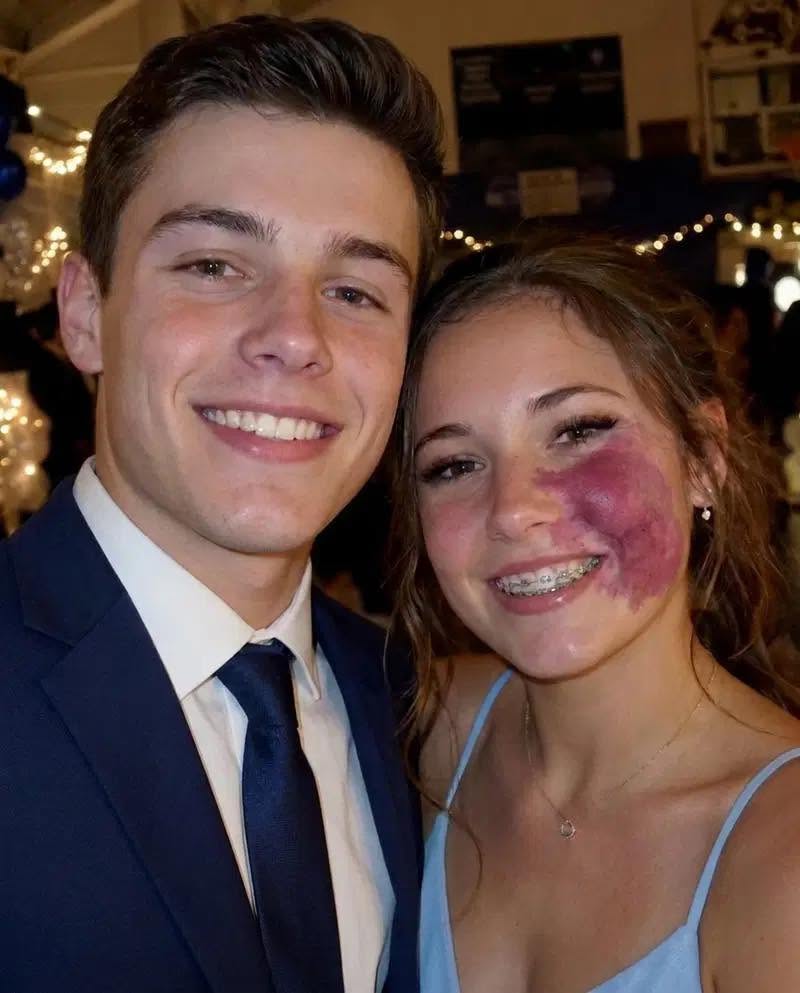 Slechts één jongen vroeg me mee naar het schoolbal, omdat niemand anders met me wilde gaan vanwege de moedervlek op mijn gezicht. Iedereen lachte, totdat er politieagenten de gymzaal binnenkwamen.