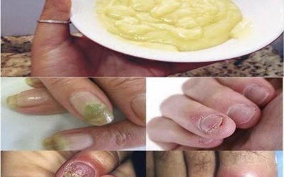 Het verborgen gevaar van nagelinfecties en hoe een eenvoudige natuurlijke remedie je kan helpen ze te bestrijden.