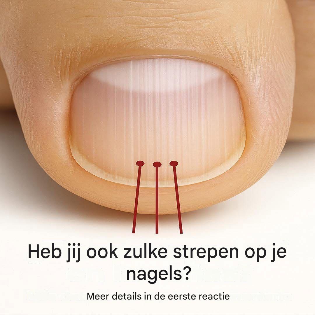 Nagelstrepen: Wat je lichaam je misschien probeert te vertellen