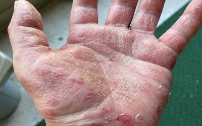 Dermatitis op de handen: wanneer de huid luider spreekt dan woorden