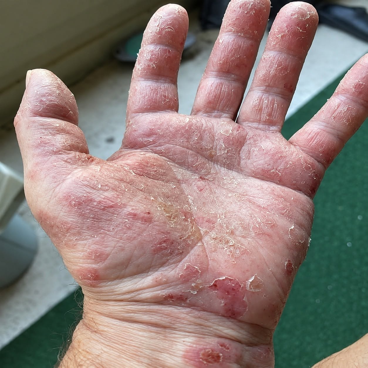 Dermatitis op de handen: wanneer de huid luider spreekt dan woorden