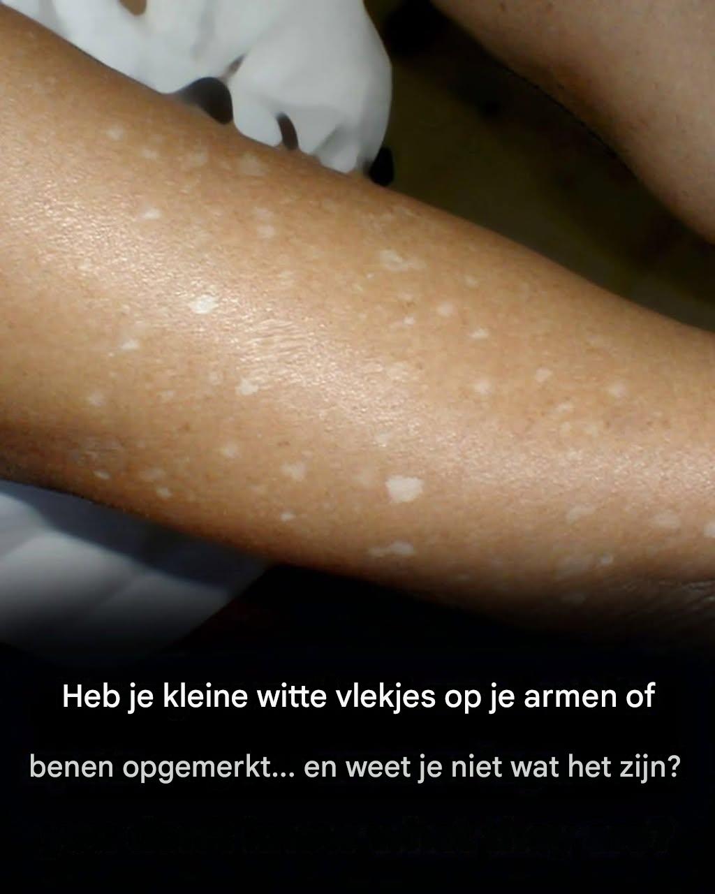 Heb je kleine witte vlekken op je armen of benen opgemerkt? Dit zijn wat ze zijn
