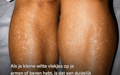 Wat zit er achter die witte vlekken op je huid?
