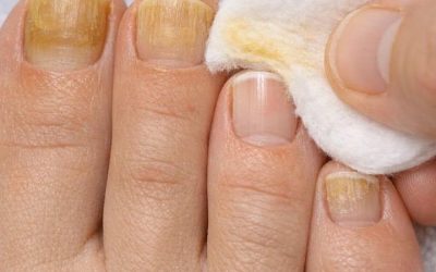 Wrijf deze ene truc op je nagels en verwijder hardnekkige vlekken, gele ophoping en ruwe textuur