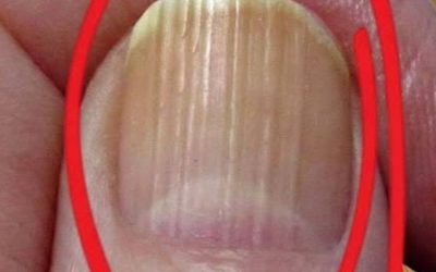 🧴💅 Als je strepen op je nagels hebt, betekent dat dat je kanker hebt… Wat het echt betekent 😲🧠