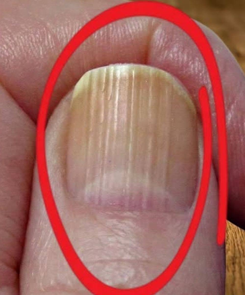 🧴💅 Als je strepen op je nagels hebt, betekent dat dat je kanker hebt… Wat het echt betekent 😲🧠