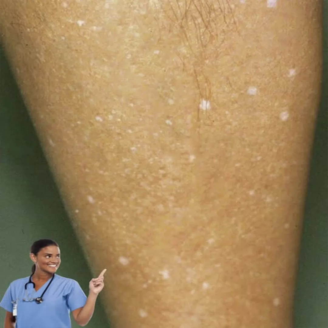 Wat zit er achter die witte vlekken op je huid?