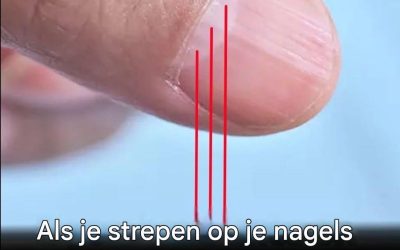 Arts ontdekt een duidelijk teken in je nagels dat je levensverwachting kan voorspellen