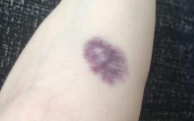 WEES VOORZICHTIG, als je deze blauwe plekken op je lichaam krijgt, betekent dit dat je kanker hebt… zie meer