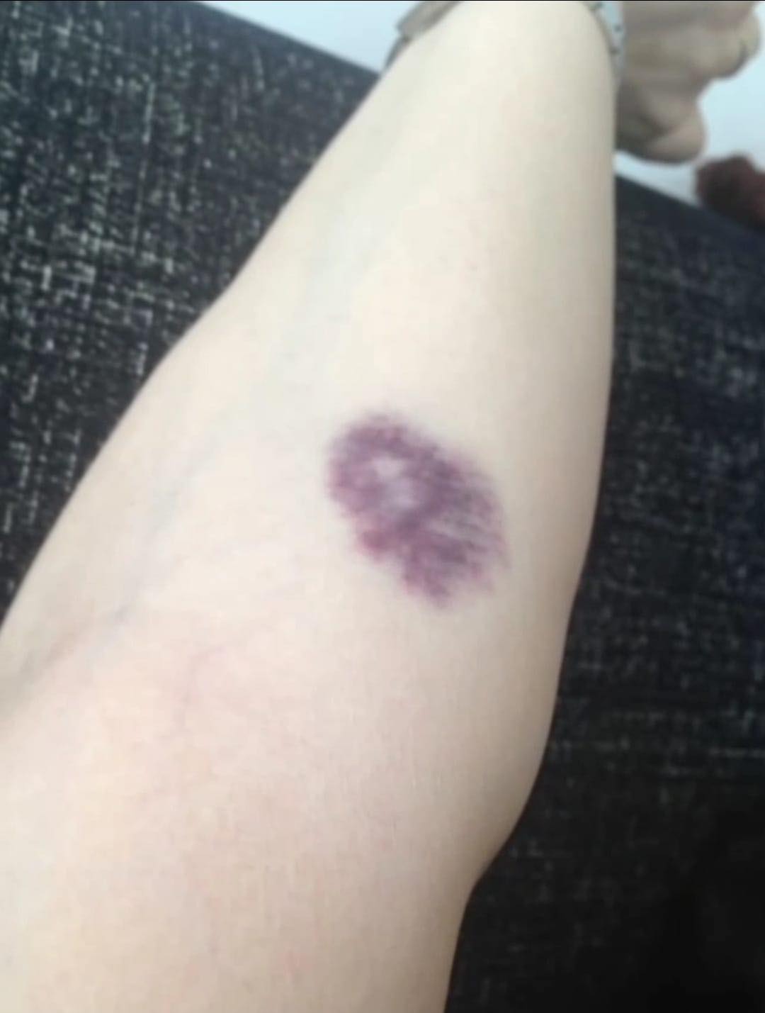 WEES VOORZICHTIG, als je deze blauwe plekken op je lichaam krijgt, betekent dit dat je kanker hebt… zie meer