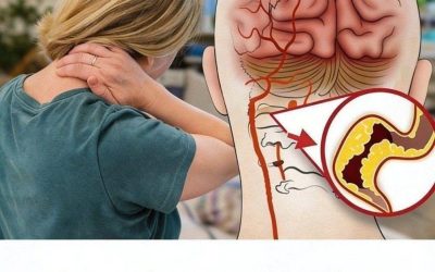 10 vroege waarschuwingssignalen van een beroerte die iedereen moet kennen om direct actie te kunnen ondernemen.