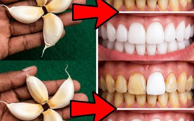 Een stralende glimlach dankzij knoflook: mythe of werkelijkheid?