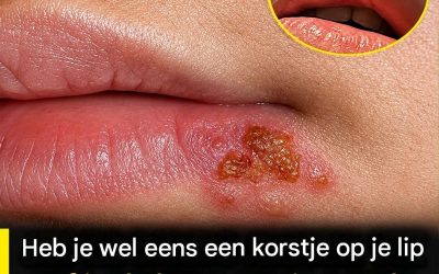Heb je wel eens een korstje op je lip gehad?