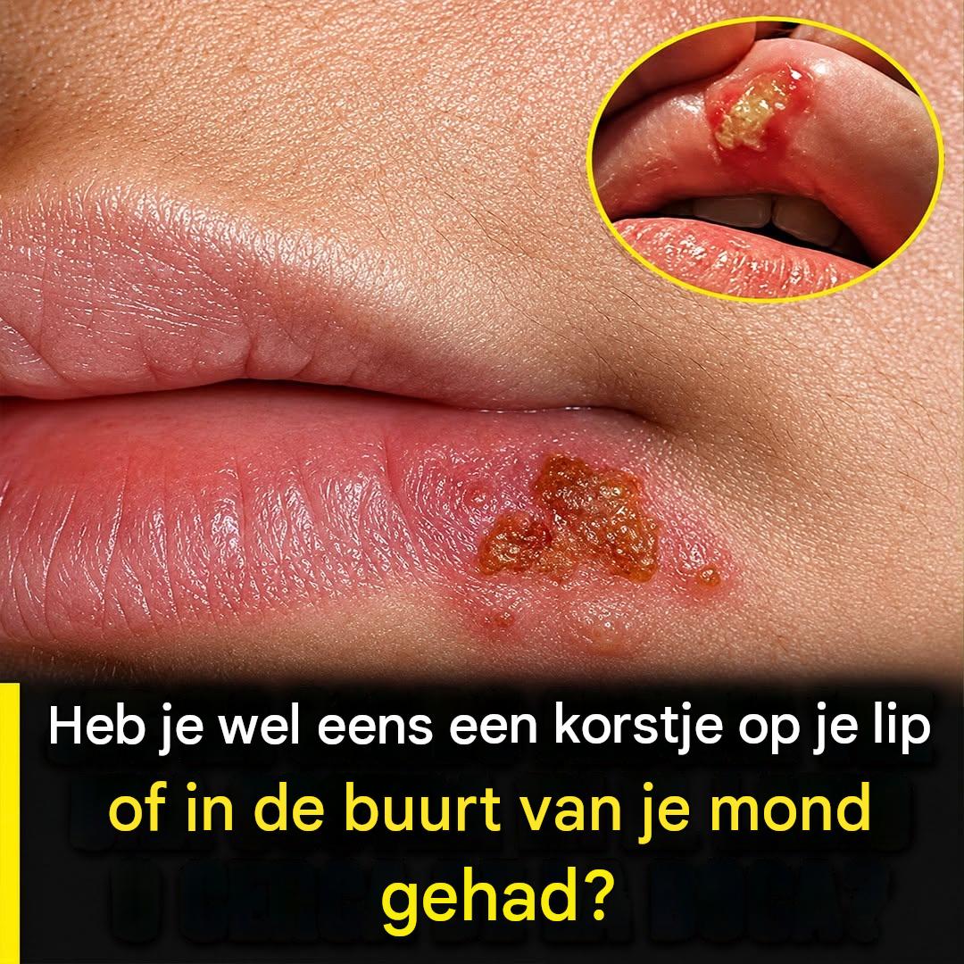 Heb je wel eens een korstje op je lip gehad?