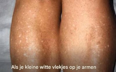 Als je kleine witte vlekjes op je armen of benen hebt, is dat een duidelijk teken dat… Lees meer