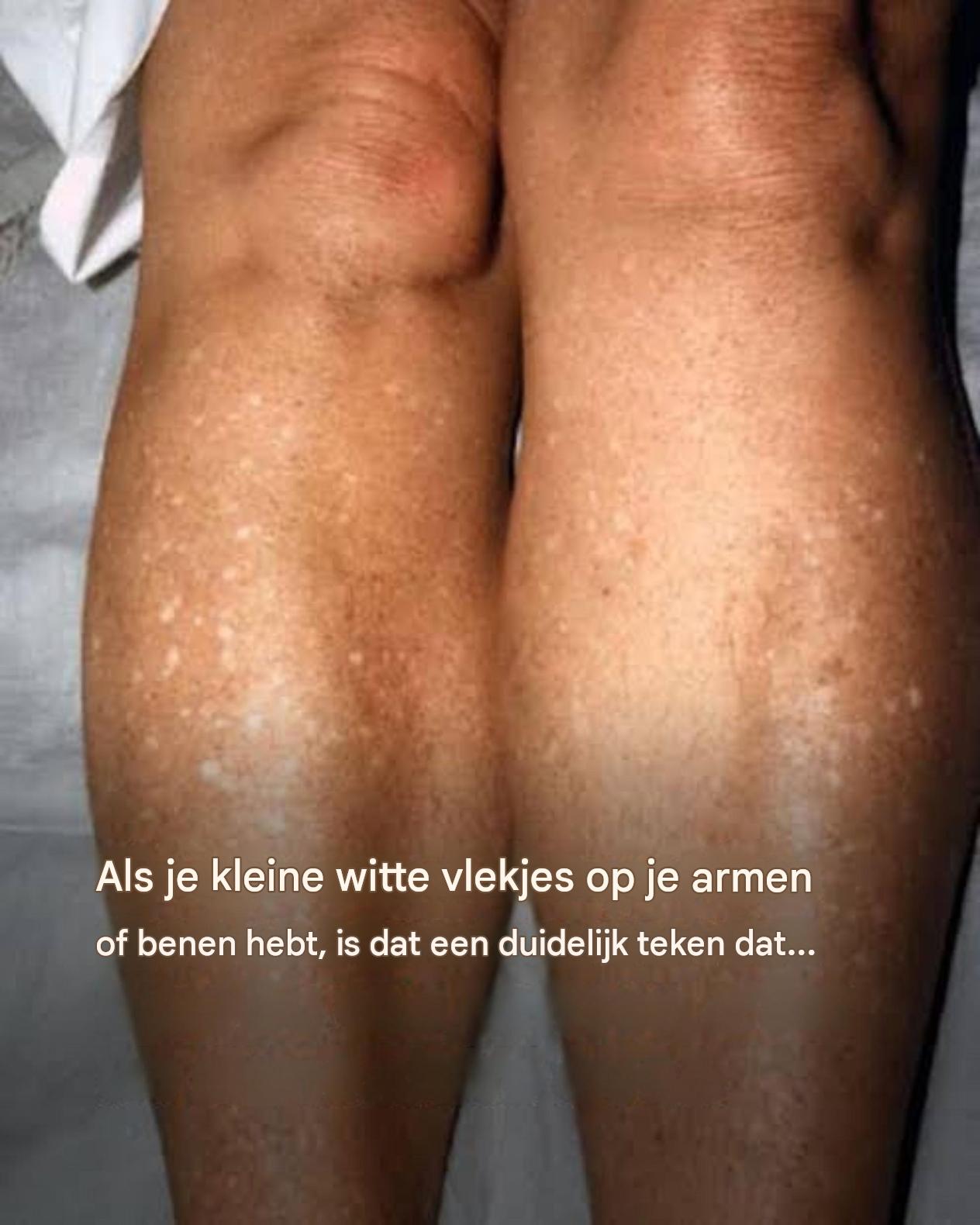 Als je kleine witte vlekjes op je armen of benen hebt, is dat een duidelijk teken dat… Lees meer